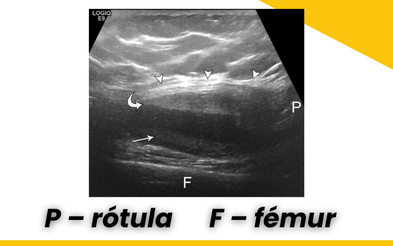 1. Evaluacion rodilla ecografia.png